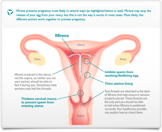 Diagram of Mirena coil in uterus
